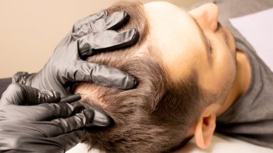 Vorteile der Haarpigmentierung: Mann wird am Hinterkopf pigmentiert
