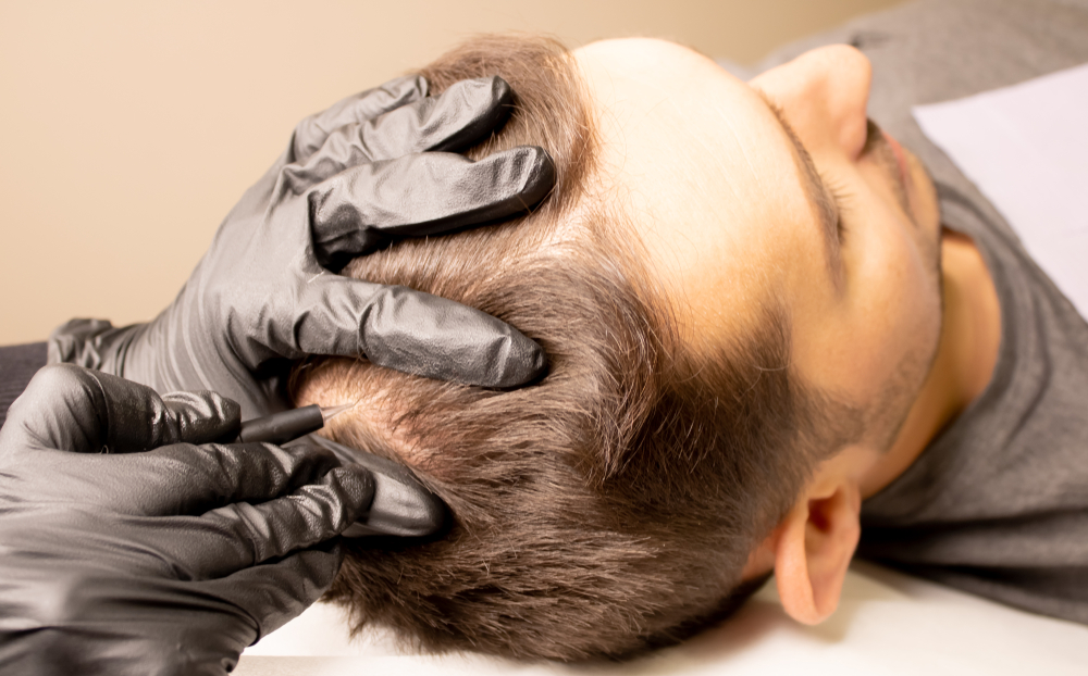 Vorteile der Haarpigmentierung: Mann wird am Hinterkopf pigmentiert