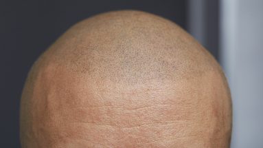 Haarpigmentierung oder Haartransplantation: Mann mit pigmentiertem Kopf